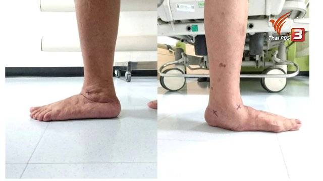 รู้สู้โรค : เท้าแบนในผู้สูงอายุ