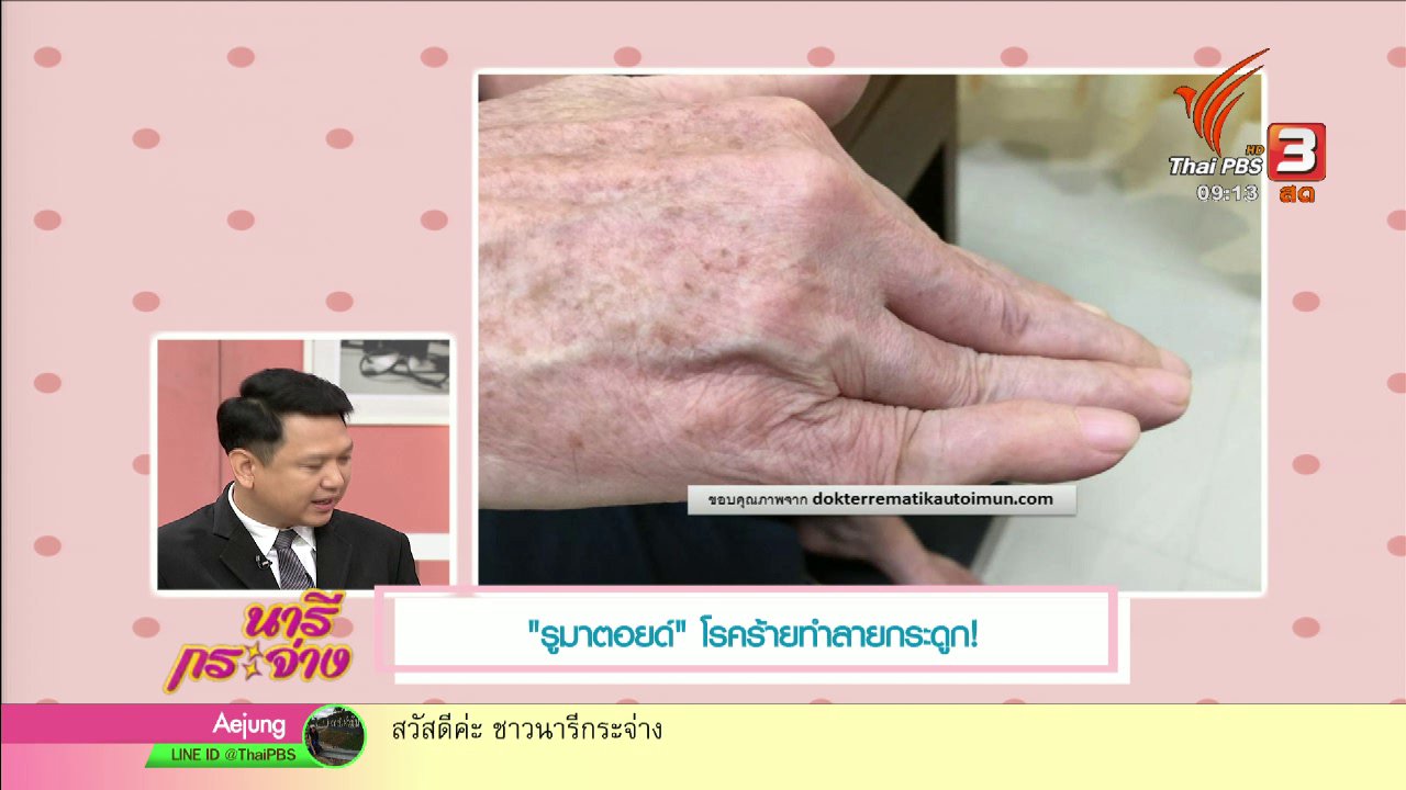 นารีกระจ่าง - นารีสนทนา : "รูมาตอยด์" ทำลายกระดูกจริงหรือ?