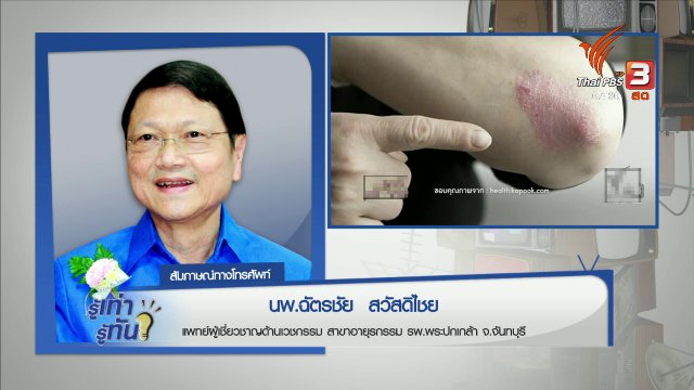 โรคข้ออักเสบสะเก็ดเงิน