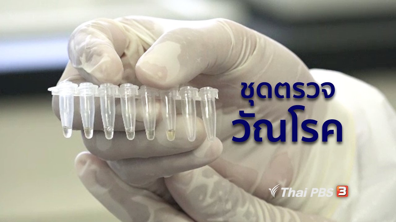 คนสู้โรค - รู้สู้โรค : กรมวิทยาศาสตร์การแพทย์พัฒนาชุดตรวจวัณโรค