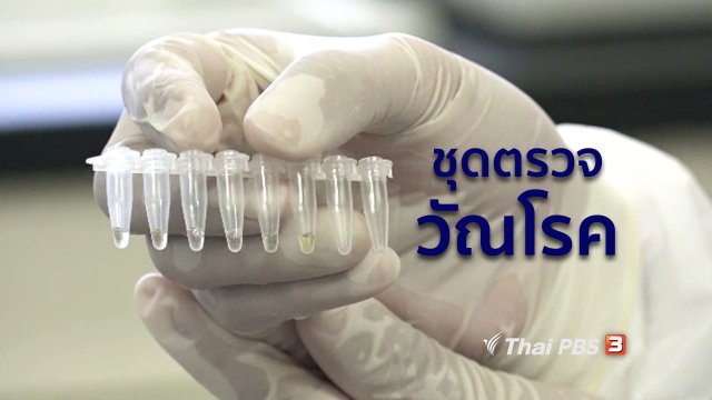 รู้สู้โรค : กรมวิทยาศาสตร์การแพทย์พัฒนาชุดตรวจวัณโรค