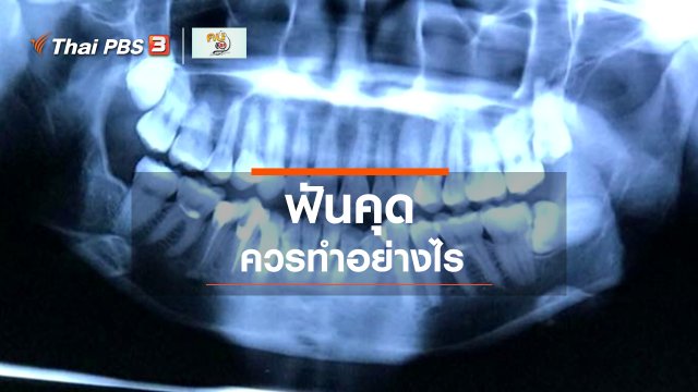 รู้สู้โรค : "ฟันคุด" ควรทำอย่างไร