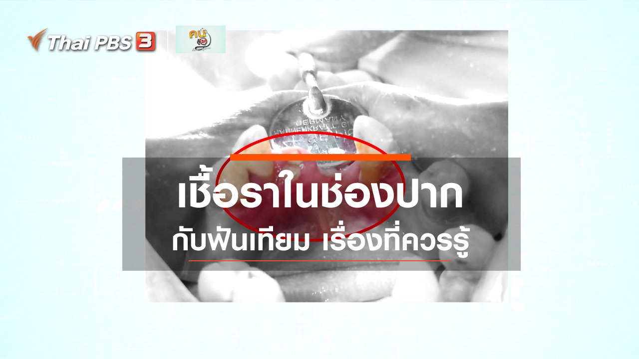 คนสู้โรค - รู้สู้โรค : เชื้อราในช่องปากกับฟันเทียม