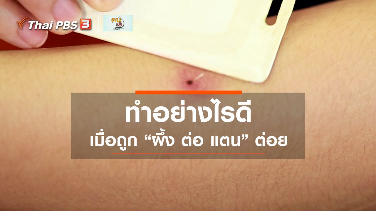 คนสู้โรค - รู้สู้โรค : ปฐมพยาบาลผู้ถูกสัตว์มีพิษกัดต่อย
