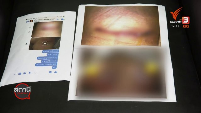 สถานีร้องเรียน : ฟ้องเรียกค่าเสียหาย คลินิกทำศัลยกรรมหน้าอกเน่า จ.ปทุมธานี