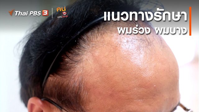 รู้สู้โรค : แนวทางรักษาผมร่วง ผมบาง