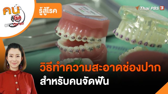 รู้สู้โรค : วิธีทำความสะอาดช่องปากสำหรับคนจัดฟัน