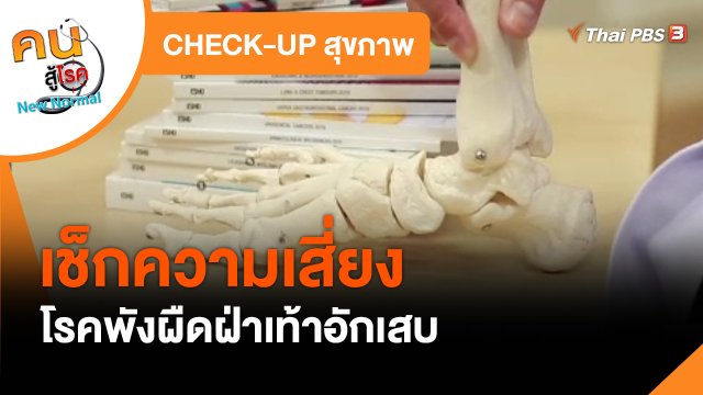 CHECK-UP สุขภาพ : เช็กความเสี่ยงเป็นโรคพังผืดฝ่าเท้าอักเสบ