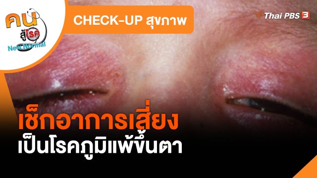 CHECK-UP สุขภาพ : เช็กอาการเสี่ยงเป็นโรคภูมิแพ้ขึ้นตา