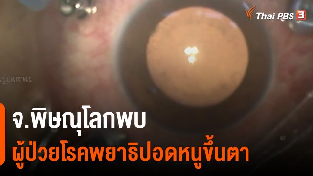 ​จ.พิษณุโลกพบผู้ป่วยโรคพยาธิปอดหนูขึ้นตา